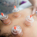 Cupping Therapy for Detoxification: A Natural Solution to Improve Skin, Hair, and Weight Loss